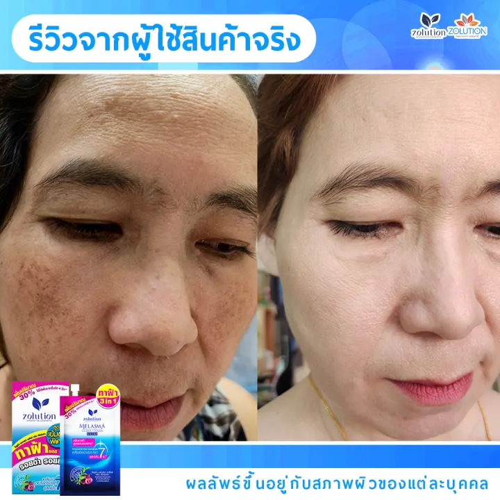 รีวิวก่อน-หลัง ผู้ใช้ครีมทาฝ้าซองน้ำเงิน 2
