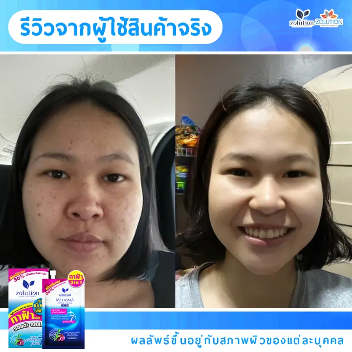 รีวิวก่อน-หลัง ผู้ใช้ครีมทาฝ้าซองน้ำเงิน 4